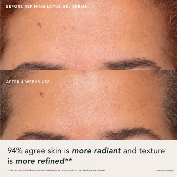 Two images comparing a woman's forehead before and after 4 weeks of using Refining Lotus Gel Creme with areas of improvement highlighted. 94% agree skin is more radiant and texture is more refined. Third party administered testing with observed results and self assessment by scoring of 34 subjects over 4 weeks. Unretouched imagery.